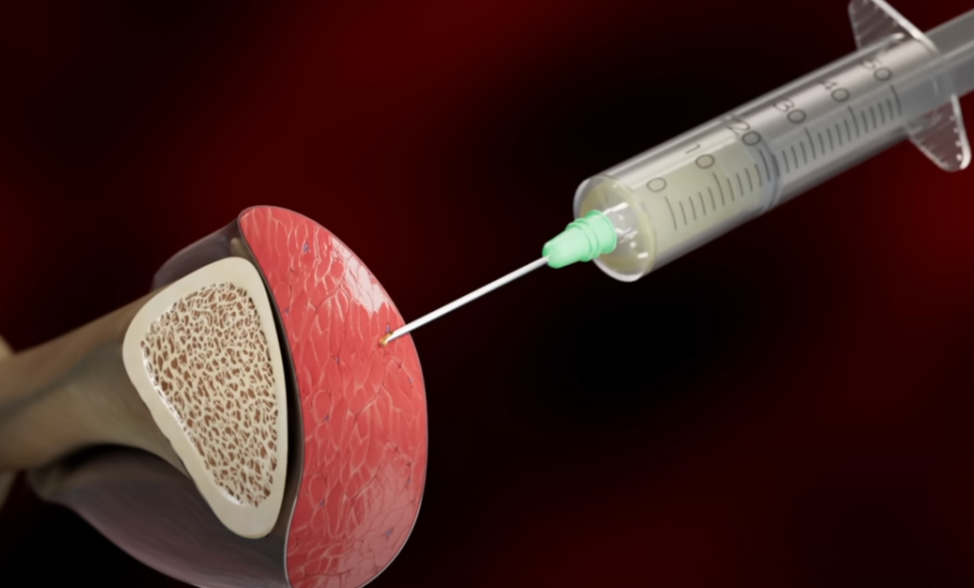 steroides anabolisants musculation